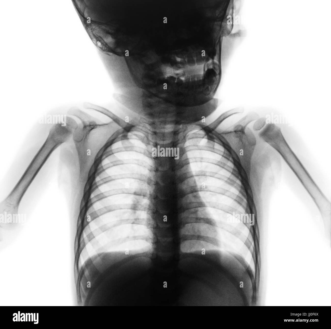 Film x-ray normale del torace del neonato . La metà superiore del corpo . Vista frontale . Foto Stock