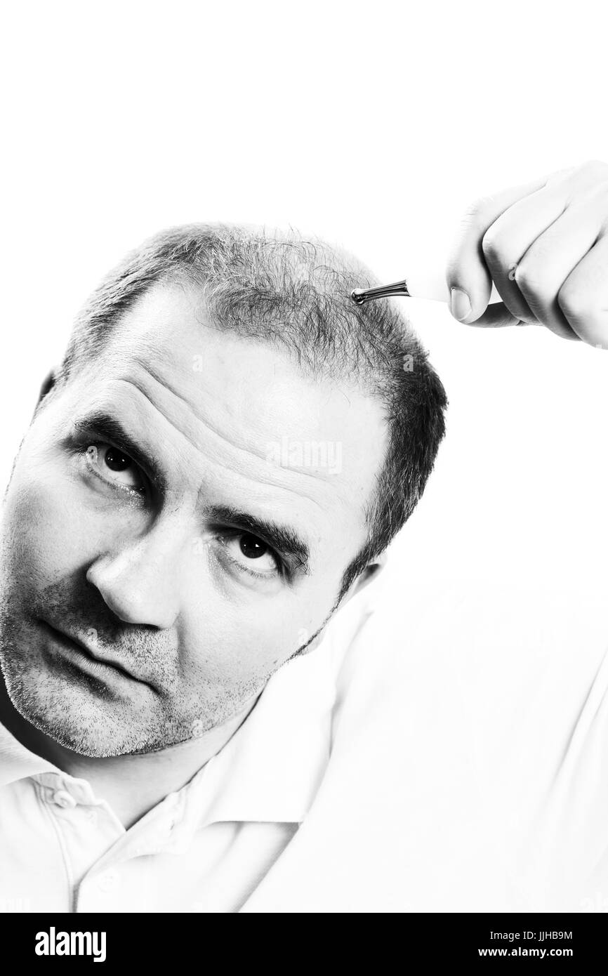 Uomo di mezza età interessate dalla perdita di capelli bald calvizie alopecia in bianco e nero Foto Stock