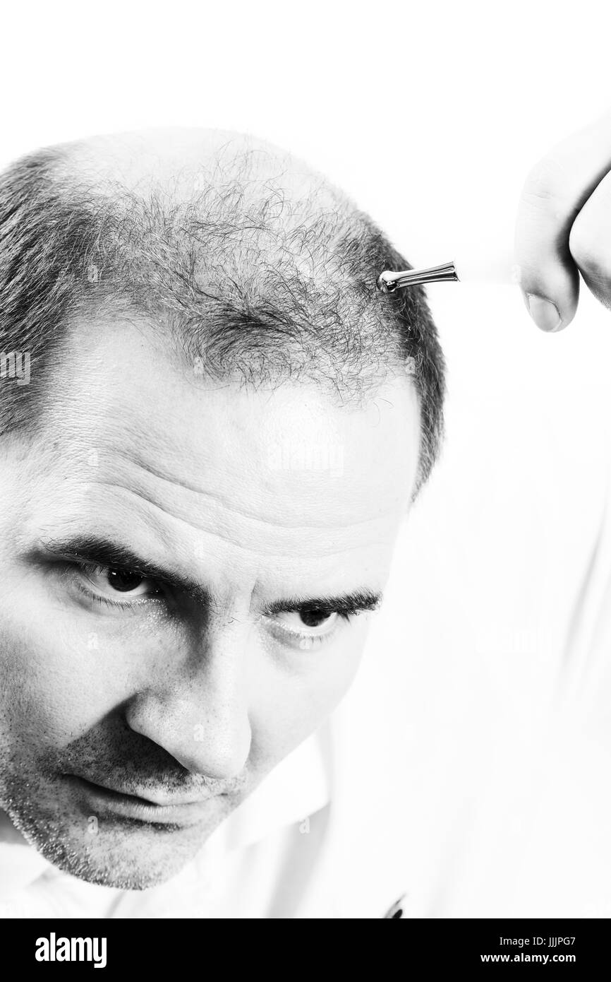 Uomo di mezza età interessate dalla perdita di capelli bald calvizie alopecia in bianco e nero Foto Stock