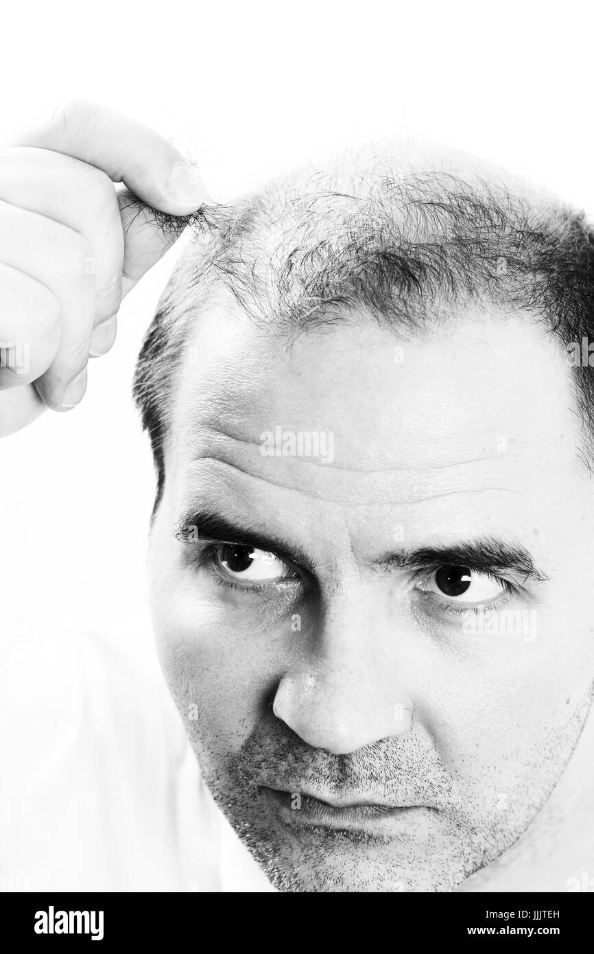 Uomo di mezza età interessate dalla perdita di capelli bald calvizie alopecia in bianco e nero Foto Stock