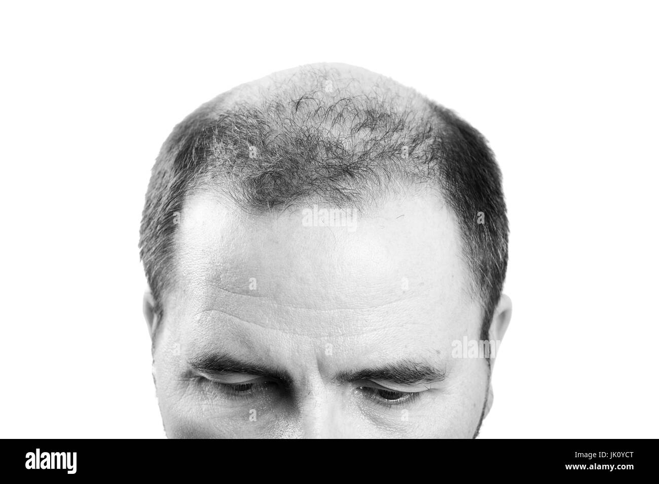 Uomo di mezza età interessate dalla perdita di capelli bald calvizie alopecia in bianco e nero Foto Stock
