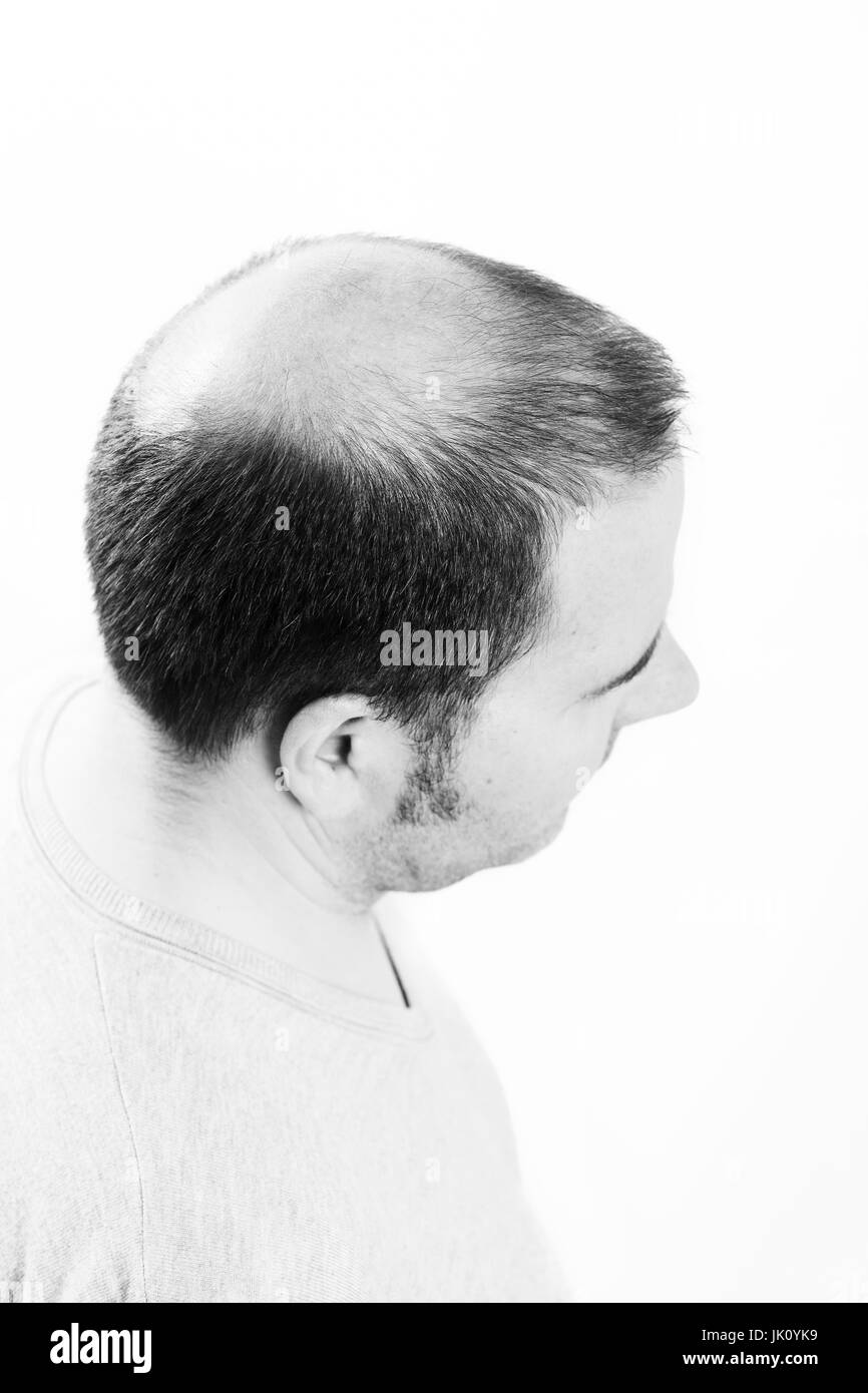 Uomo di mezza età interessate dalla perdita di capelli bald calvizie alopecia in bianco e nero Foto Stock
