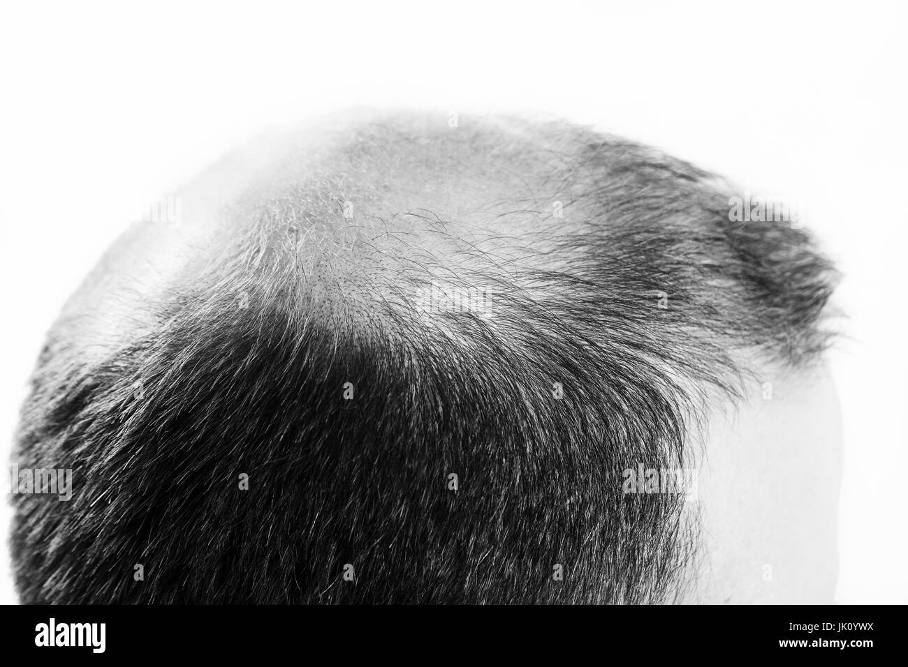 Uomo di mezza età interessate dalla perdita di capelli bald calvizie alopecia in bianco e nero Foto Stock