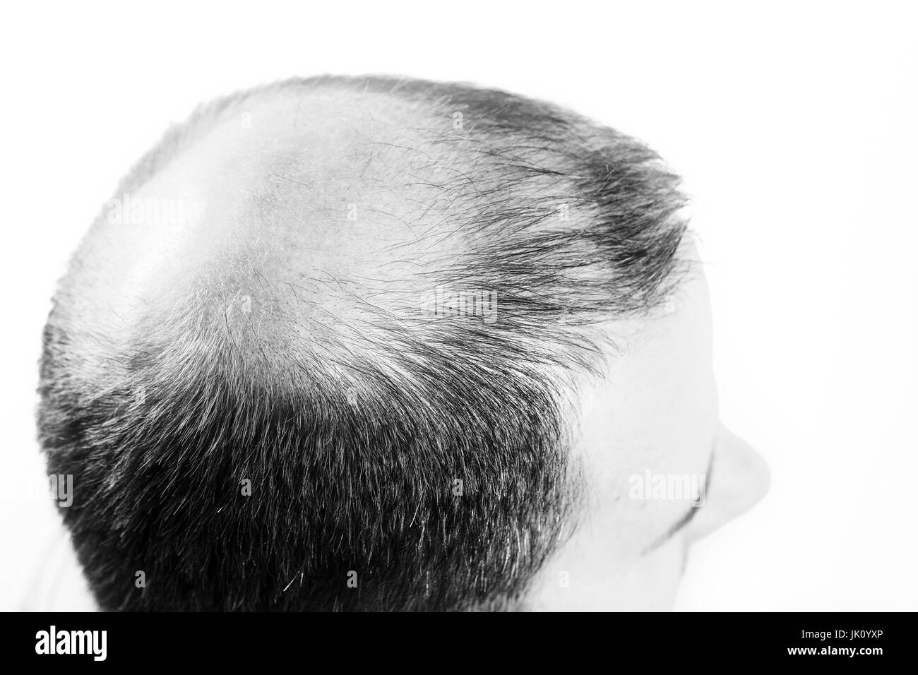 Uomo di mezza età interessate dalla perdita di capelli bald calvizie alopecia in bianco e nero Foto Stock