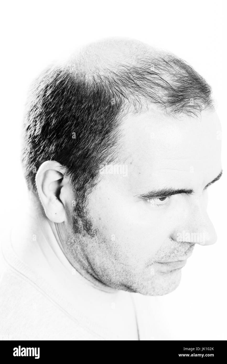 Uomo di mezza età interessate dalla perdita di capelli bald calvizie alopecia in bianco e nero Foto Stock