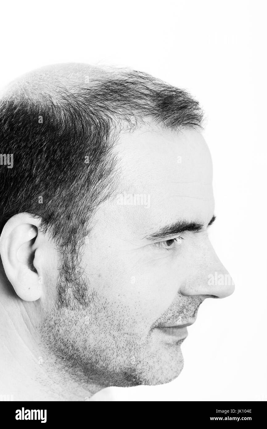 Uomo di mezza età interessate dalla perdita di capelli bald calvizie alopecia in bianco e nero Foto Stock