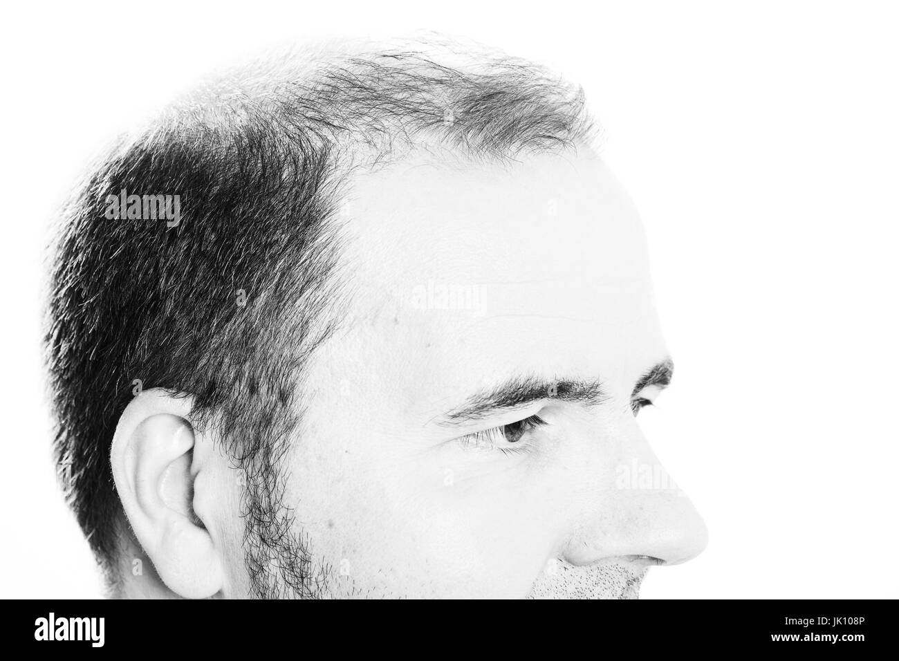 Uomo di mezza età interessate dalla perdita di capelli bald calvizie alopecia in bianco e nero Foto Stock