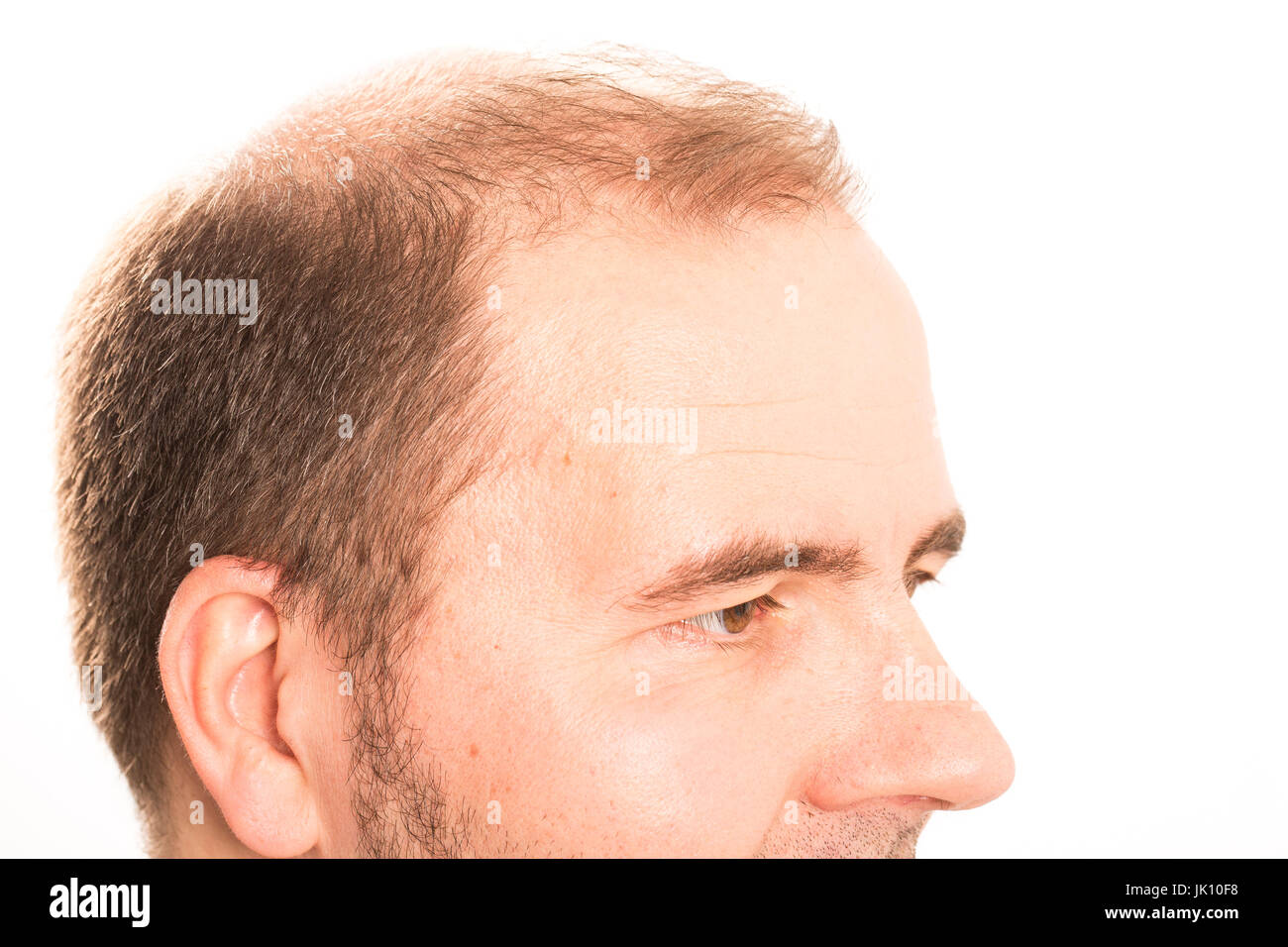 Uomo di mezza età interessate dalla perdita di capelli bald calvizie alopecia in bianco e nero Foto Stock
