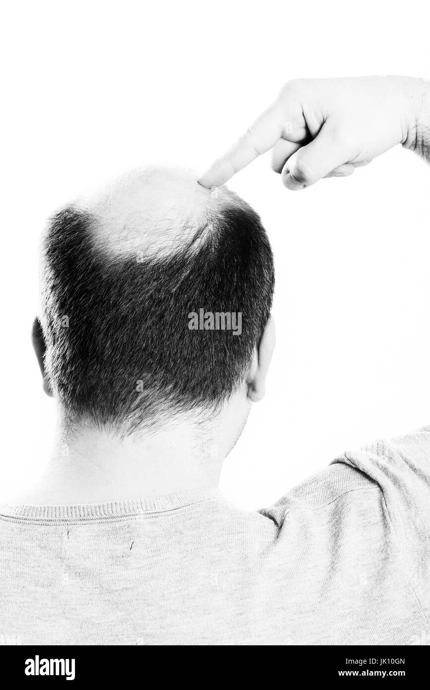 Uomo di mezza età interessate dalla perdita di capelli bald calvizie alopecia in bianco e nero Foto Stock