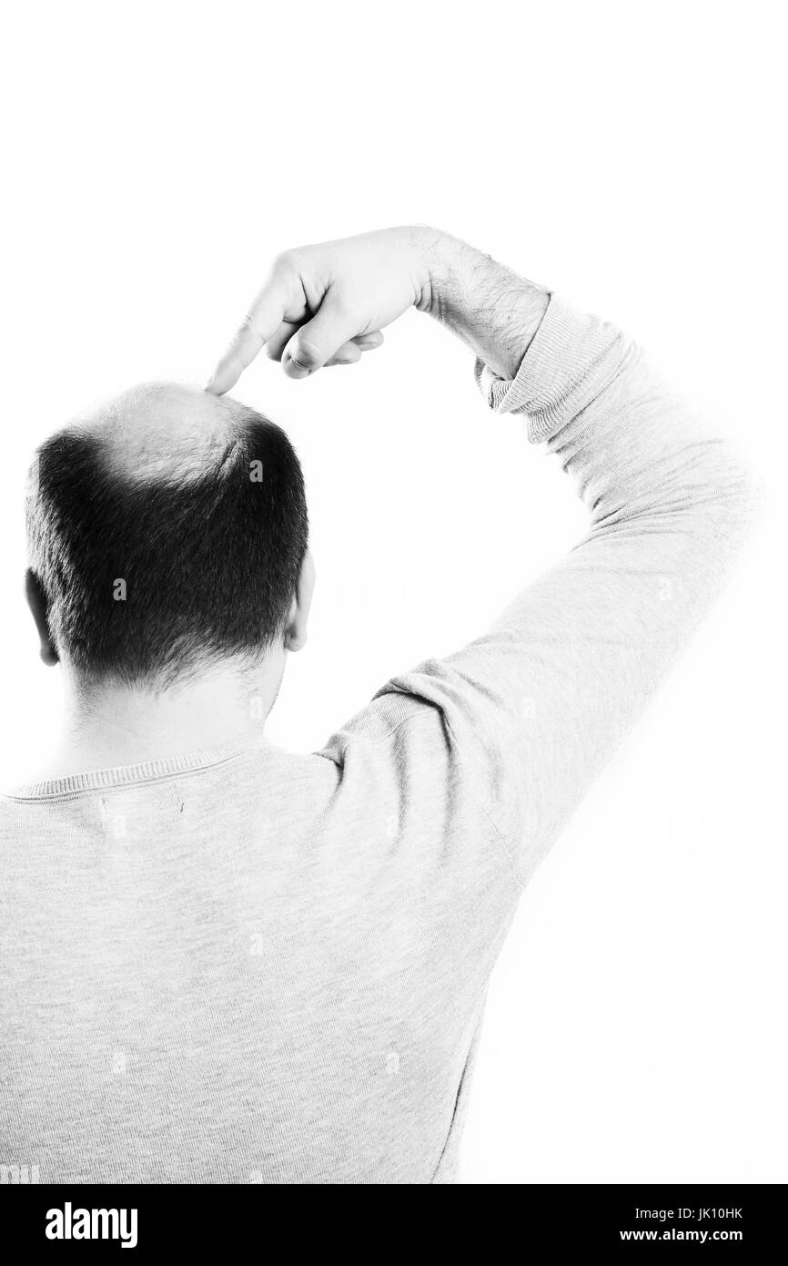 Uomo di mezza età interessate dalla perdita di capelli bald calvizie alopecia in bianco e nero Foto Stock
