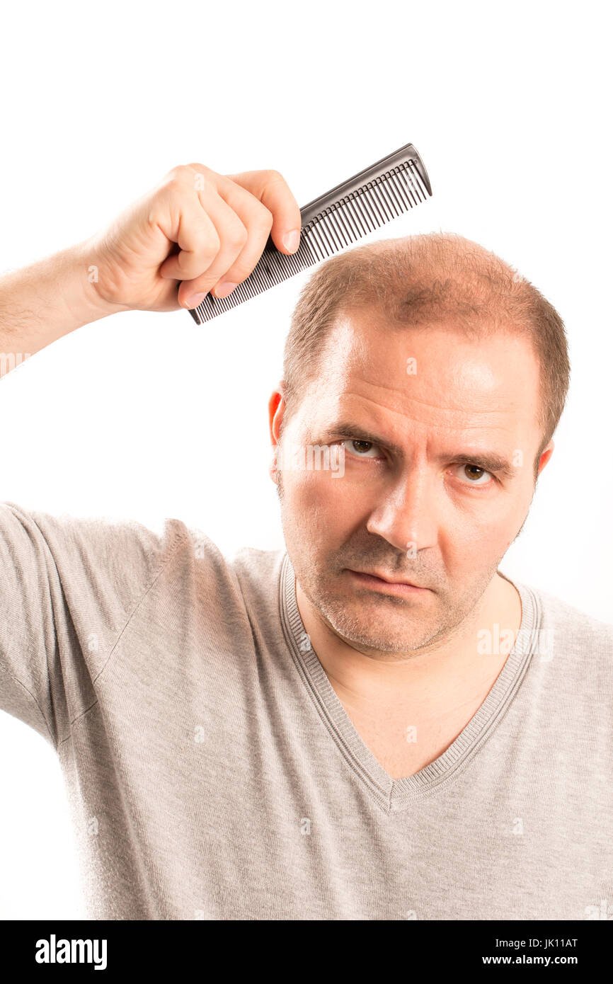 Uomo di mezza età interessate dalla perdita di capelli bald calvizie alopecia in bianco e nero Foto Stock