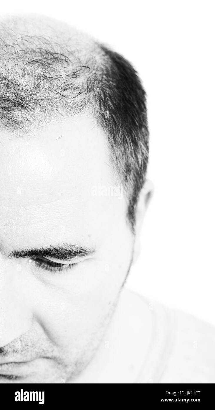 Uomo di mezza età interessate dalla perdita di capelli bald calvizie alopecia in bianco e nero Foto Stock