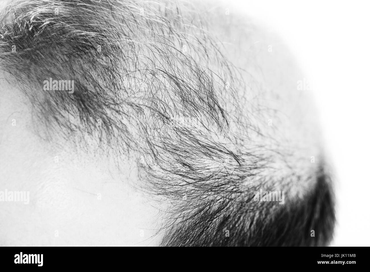 Uomo di mezza età interessate dalla perdita di capelli bald calvizie alopecia in bianco e nero Foto Stock