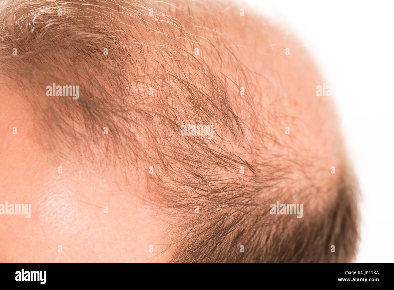 Uomo di mezza età interessate dalla perdita di capelli bald calvizie alopecia in bianco e nero Foto Stock