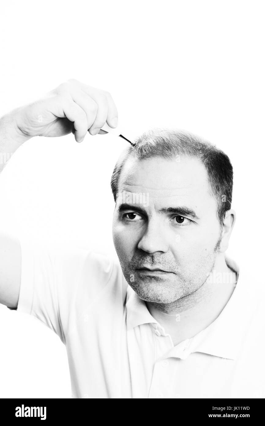 Uomo di mezza età interessate dalla perdita di capelli bald calvizie alopecia in bianco e nero Foto Stock