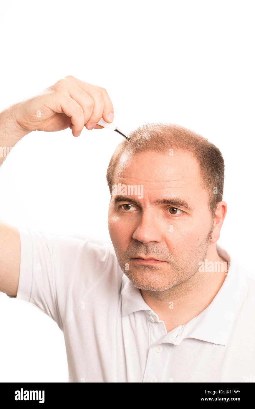Uomo di mezza età interessate dalla perdita di capelli bald calvizie alopecia in bianco e nero Foto Stock