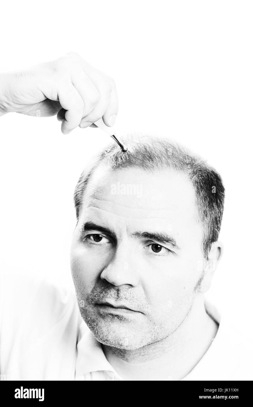 Uomo di mezza età interessate dalla perdita di capelli bald calvizie alopecia in bianco e nero Foto Stock