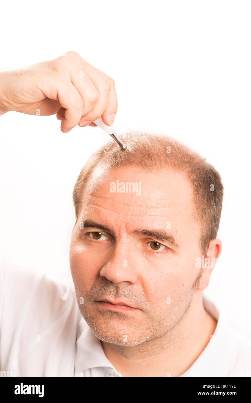 Uomo di mezza età interessate dalla perdita di capelli bald calvizie alopecia in bianco e nero Foto Stock