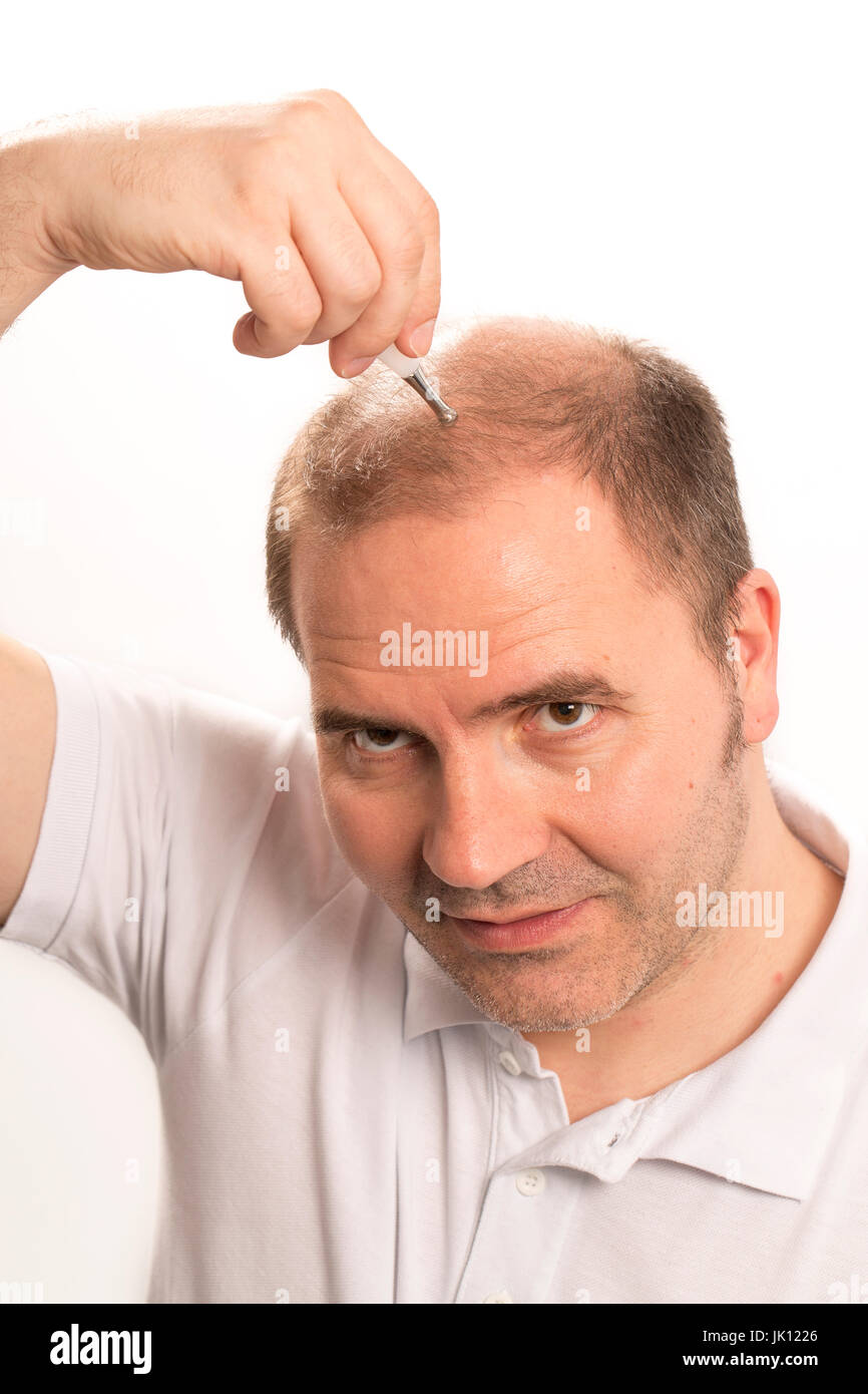 Uomo di mezza età interessate dalla perdita di capelli bald calvizie alopecia in bianco e nero Foto Stock