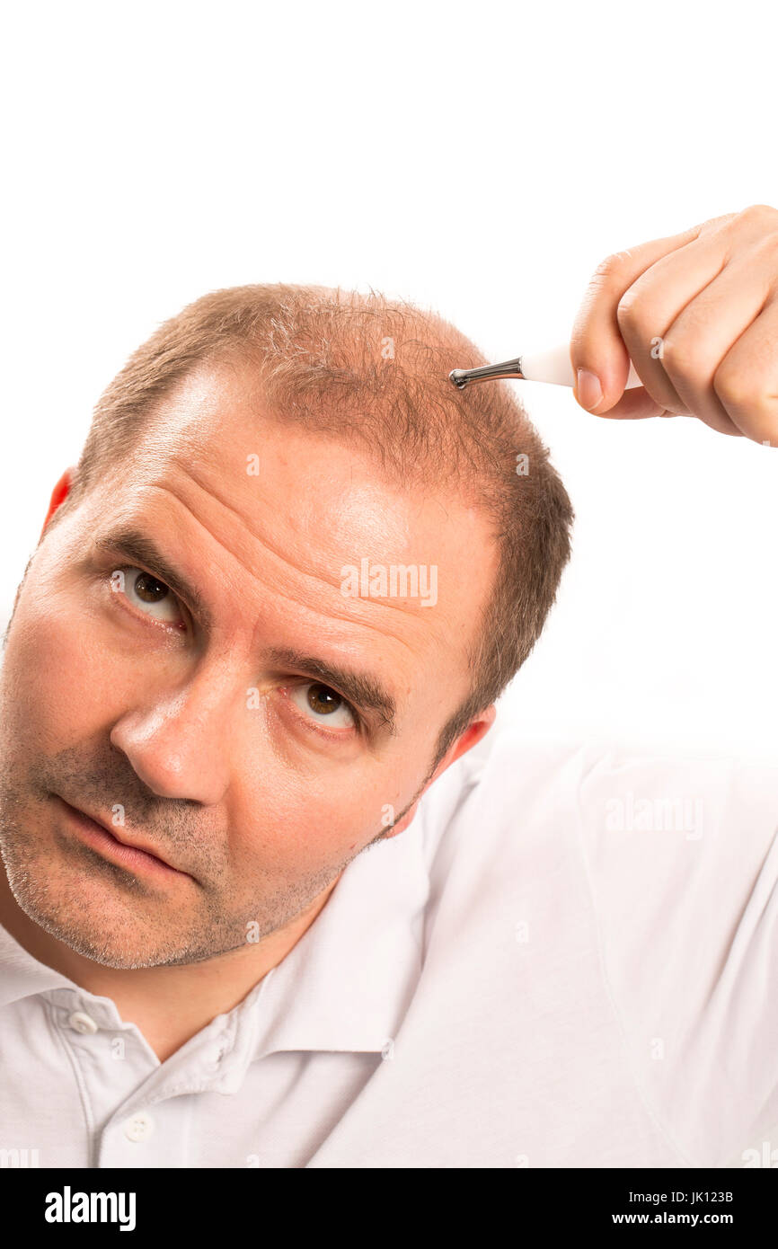 Uomo di mezza età interessate dalla perdita di capelli bald calvizie alopecia in bianco e nero Foto Stock