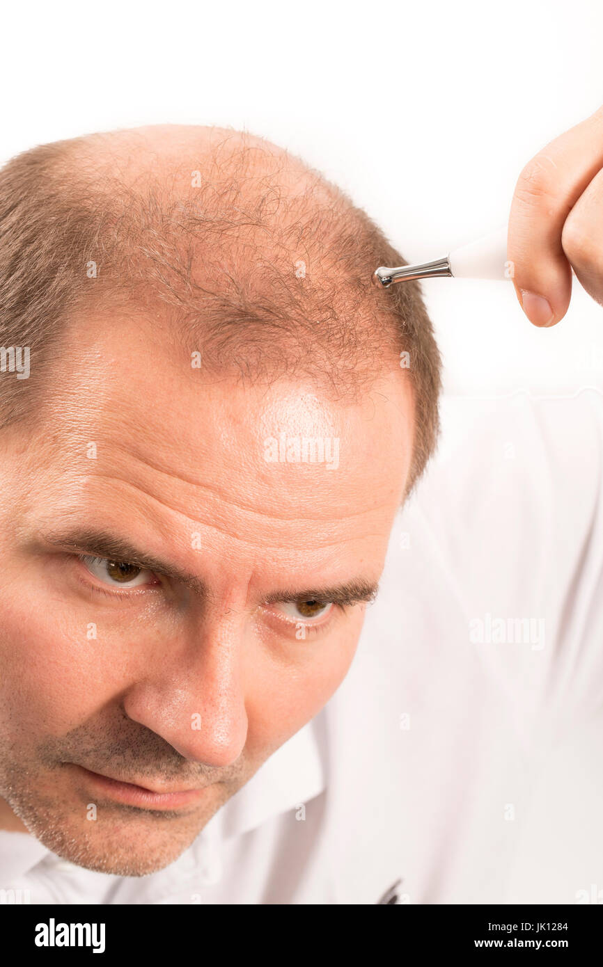 Uomo di mezza età interessate dalla perdita di capelli bald calvizie alopecia in bianco e nero Foto Stock