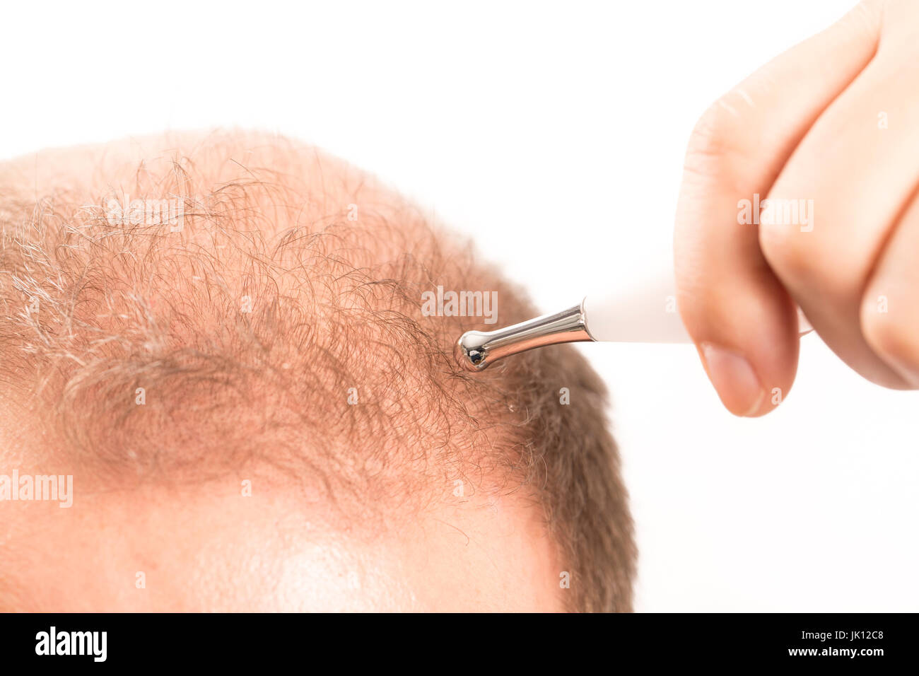 Uomo di mezza età interessate dalla perdita di capelli bald calvizie alopecia in bianco e nero Foto Stock