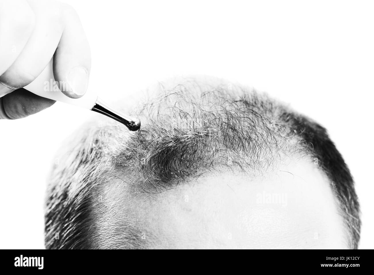 Uomo di mezza età interessate dalla perdita di capelli bald calvizie alopecia in bianco e nero Foto Stock
