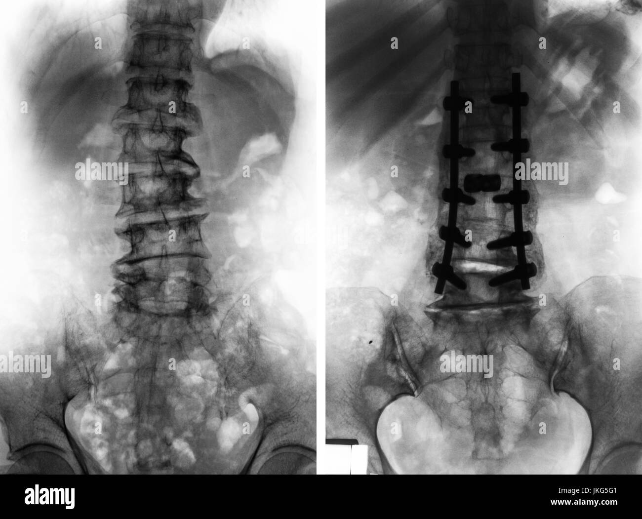 Spondilosi . Film x-ray della colonna lombare e il confronto tra la prima di un intervento chirurgico ( immagine a sinistra ) e dopo intervento chirurgico ( immagine a destra ) . Il paziente è stato azionato Foto Stock