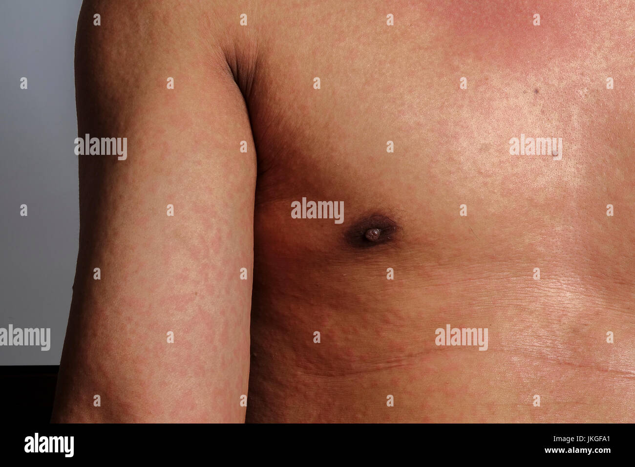 Uomo con la dermatite problema di rash ,Allergy rash Foto Stock