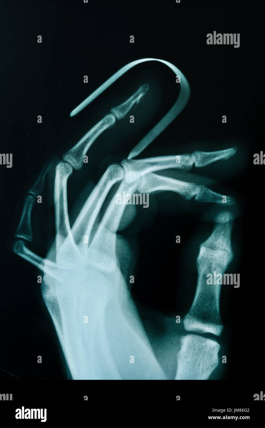 X-ray del dito rotto con apparecchiature di fissatore. Foto Stock