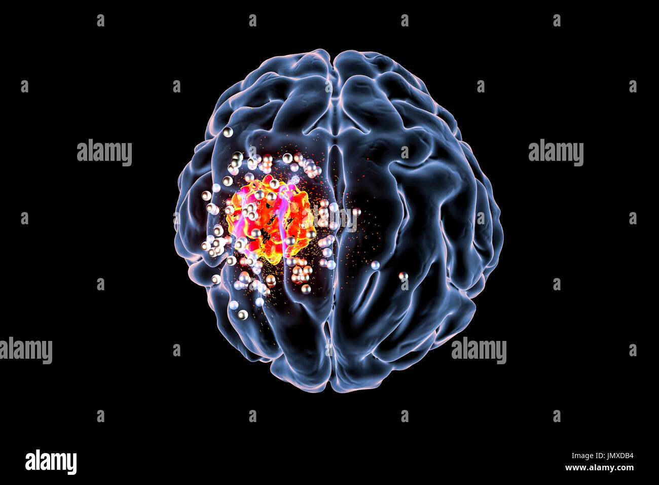 Immagine concettuale per il cancro al cervello il trattamento con la nanotecnologia. Computer illustrazione mostrante la distruzione del tumore al cervello da nanoparticelle. Foto Stock