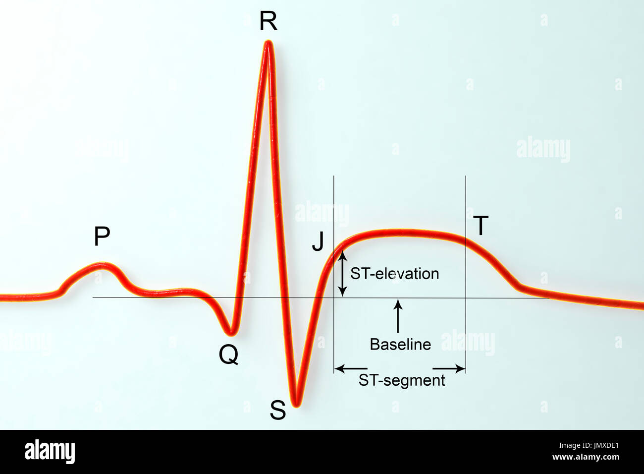 Elettrocardiogramma (ECG) durante un infarto del miocardio (attacco cardiaco). Computer illustrazione che mostra ST-elevazione che è misurata a giunzionali o punto j. Immagine marcata. Foto Stock