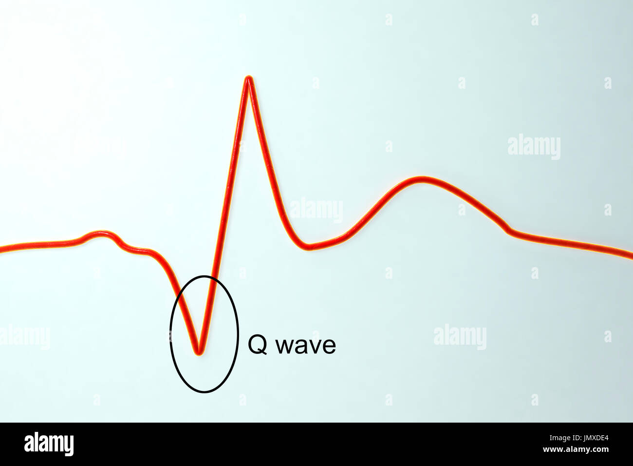Elettrocardiogramma (ECG) durante un infarto del miocardio (attacco cardiaco). Computer illustrazione che mostra la formazione di patologica onda Q. Foto Stock