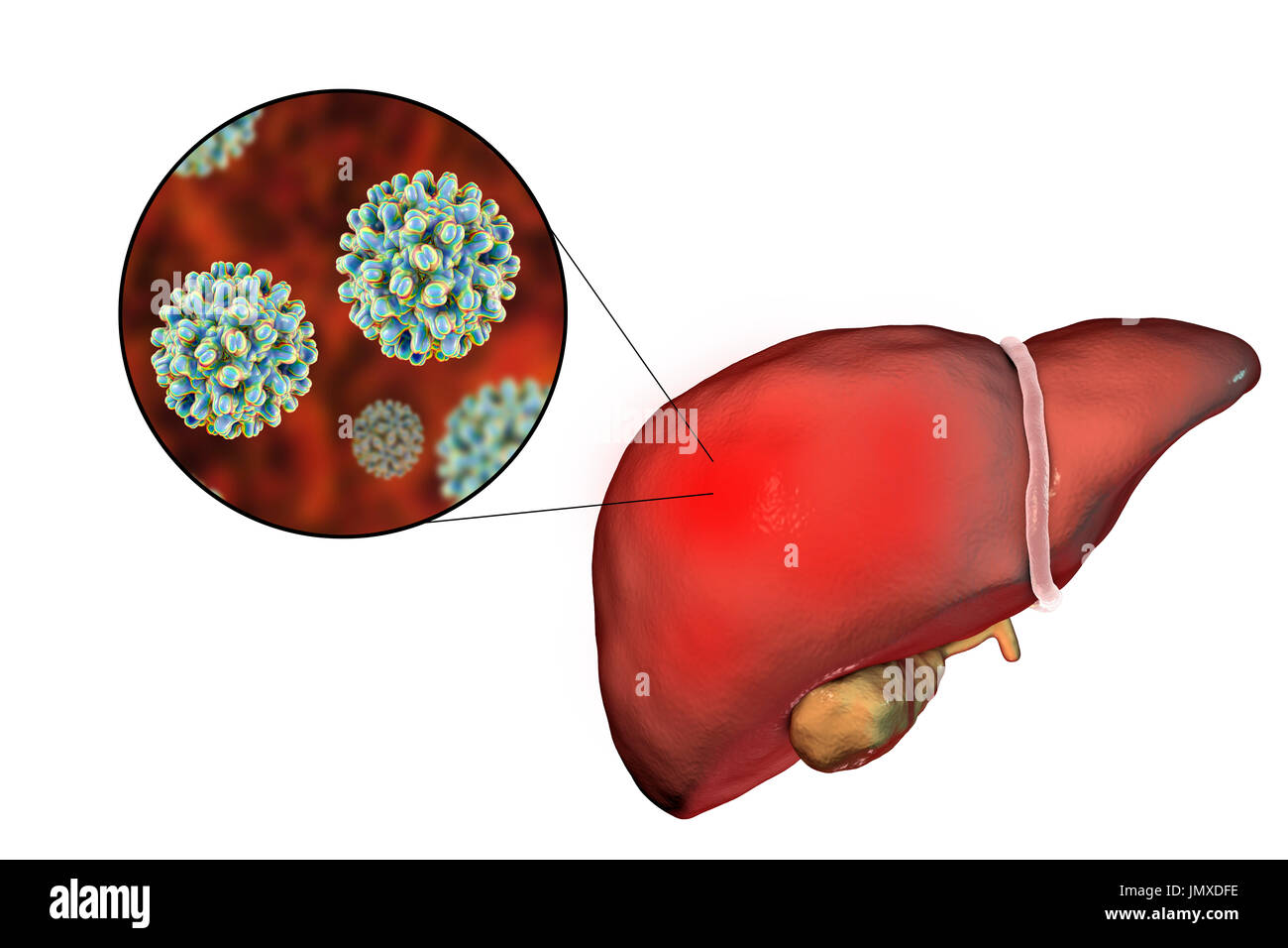 Fegato con epatite e vista ravvicinata di epatite B Virus, illustrazione. Foto Stock