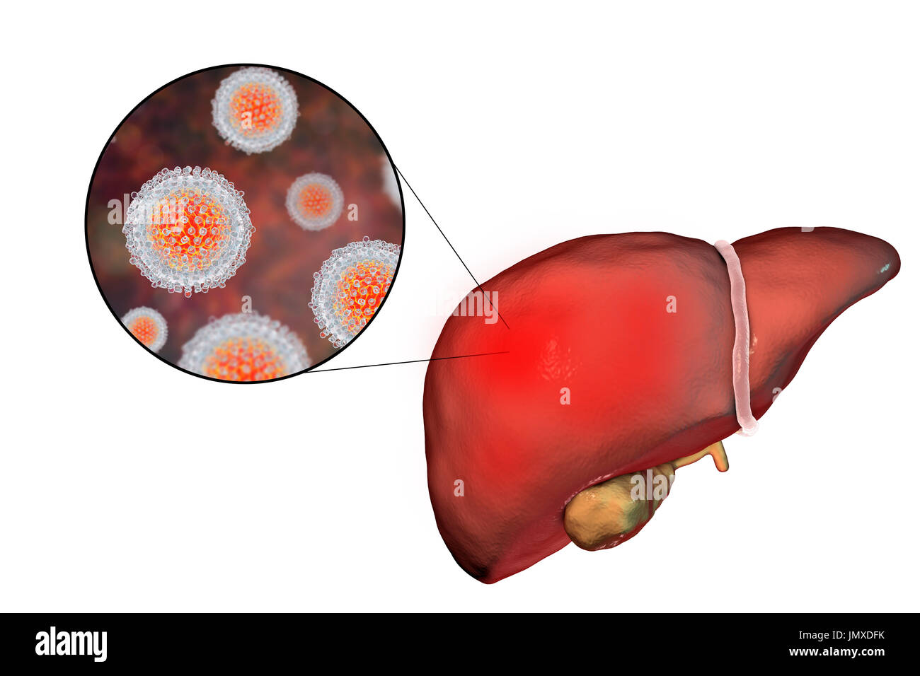 Fegato con epatite e vista ravvicinata di epatite C, virus di illustrazione. Foto Stock