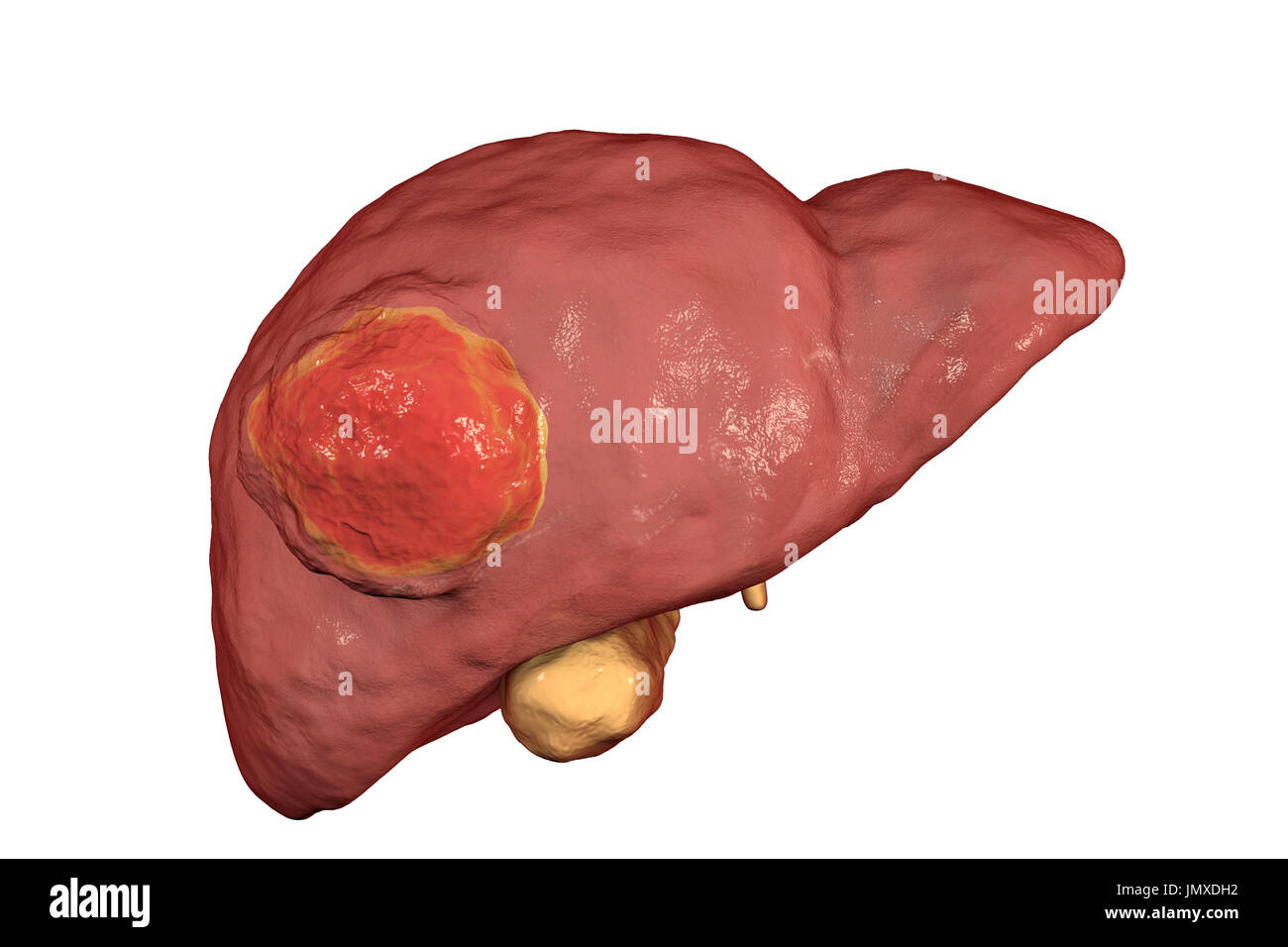 Il cancro al fegato, illustrazione del computer. Foto Stock