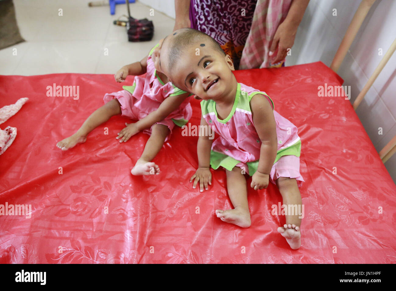 Dacca in Bangladesh. 29 Luglio, 2017. Taslima Khatun gioca con i suoi congiunti figlie gemelle Rabeya e Rokeya presso un ospedale a Dhaka, nel Bangladesh, 29 luglio 2017. Credito: Suvra Kanti Das/ZUMA filo/Alamy Live News Foto Stock