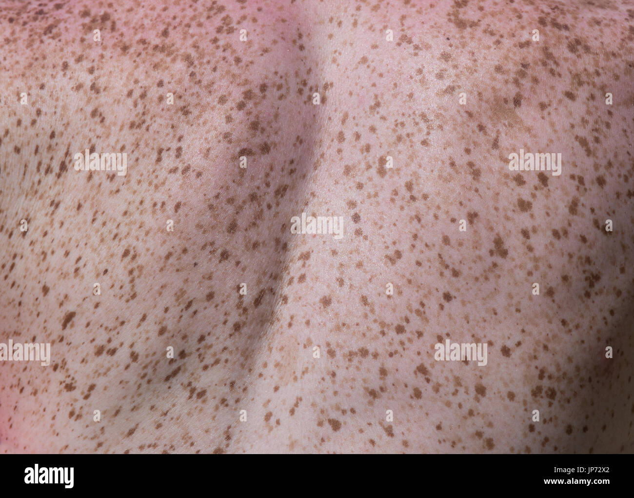 Close up di lentiggini sul retro della donna. La pelle sensibile consistenza Foto Stock