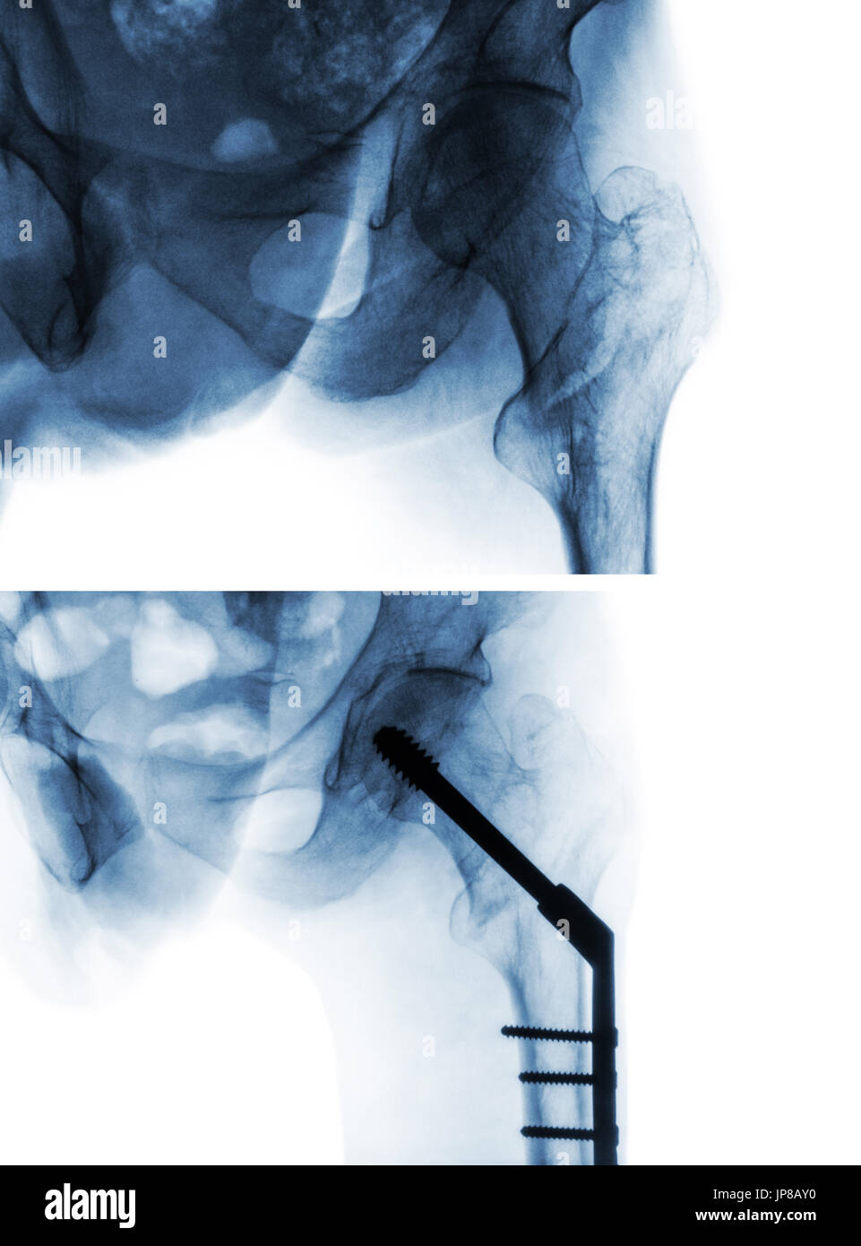 Fratture intertrocanteriche frattura femore ( thigh bone ). X-ray di hip e il confronto tra la prima di un intervento chirurgico (immagine superiore) e dopo un intervento chirurgico (immagine inferiore). Pat Foto Stock