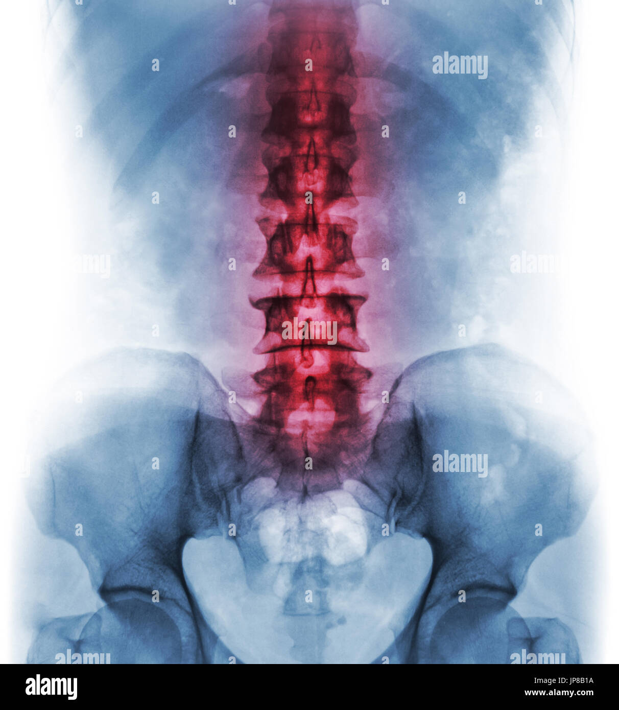 Infiammazione della colonna vertebrale lombo-sacrale . Concetto di Cura vertebrale . Foto Stock