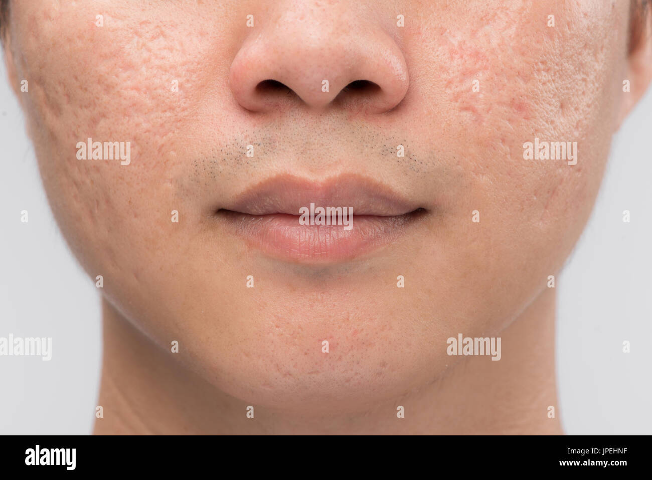 Uomo con la pelle grassa e cicatrici da acne isolato su sfondo bianco Foto  stock - Alamy