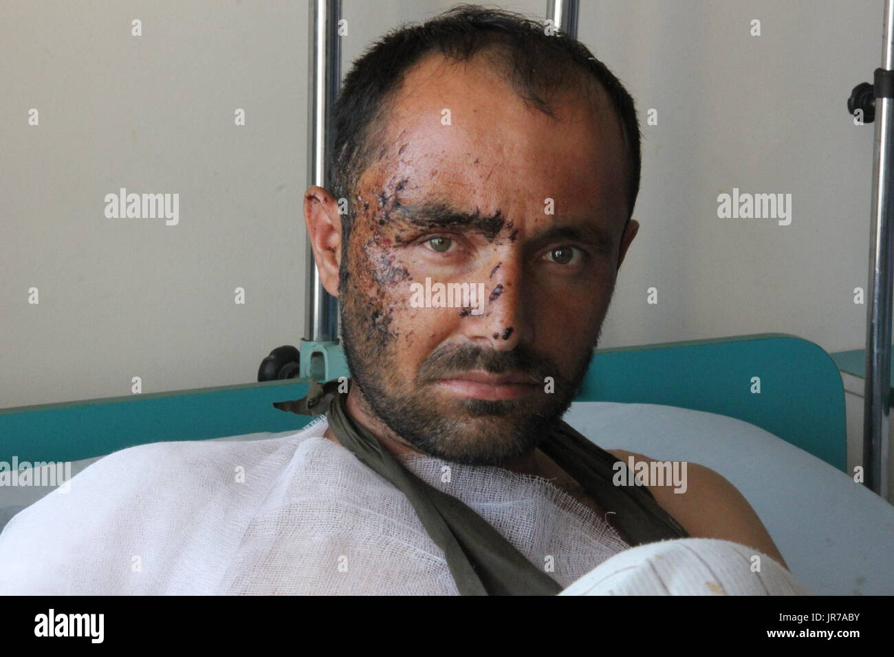 Soldato afgano Sabiuallah giacente a letto nel paese più grande ospedale militare a Kabul, la capitale dell'Afghanistan, 24 luglio 2017. Sabiullah è stato ferito il 20 luglio nella provincia centrale di Maidan Wardak quando un IED esploso davanti a lui durante una pattuglia. Shrapnel lo ha colpito nel braccio e in faccia. Foto: Christine-Felice Röhrs/dpa Foto Stock