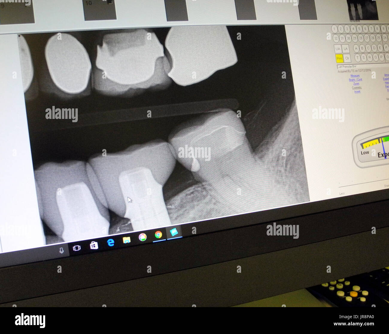 Visto su un monitor di computer schermo è un dentista digitale a raggi X che mostra le varie otturazioni dentali sulla parte superiore dei denti, e tre nuove corone di porcellana su due impianto dentale posti (sinistra) e uno su un dente naturale (a destra) sulla ganascia inferiore. Foto Stock