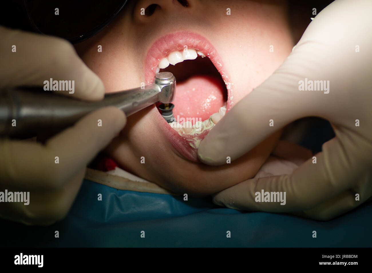 Bambino paziente avente denti puliti e lucidati con un igienista dentale in chirurgia dentale Foto Stock