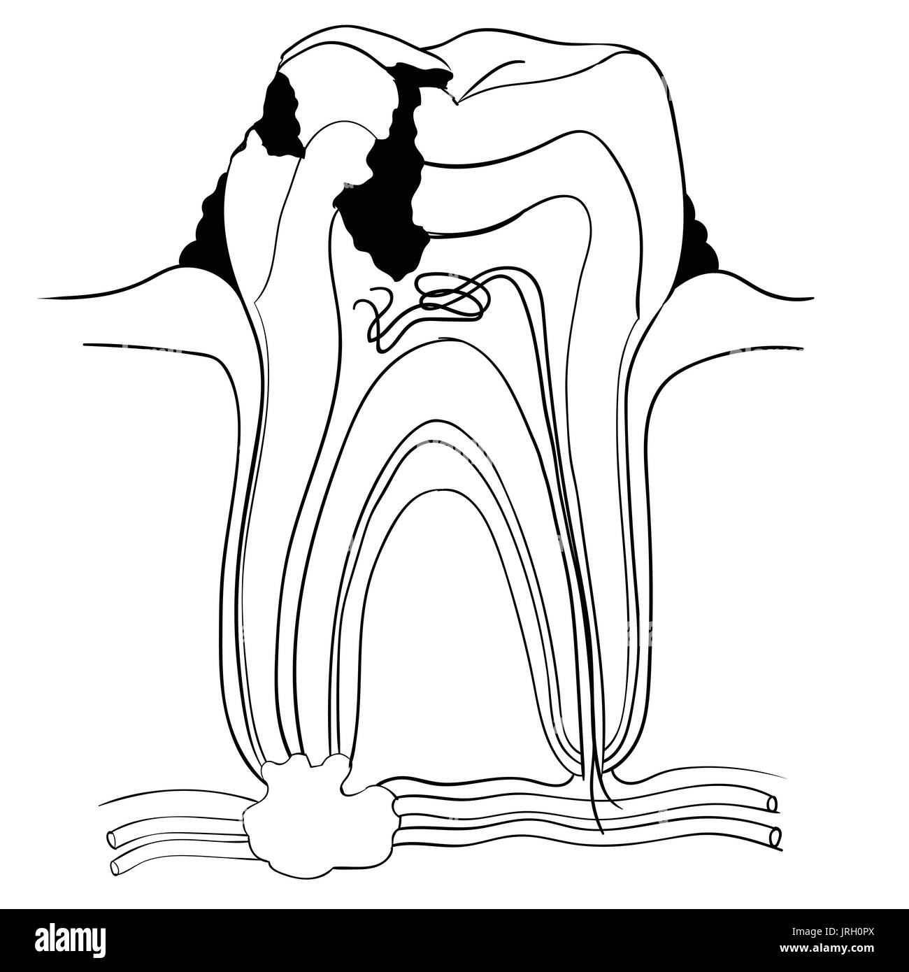 Umano anatomico del dente rotto e la carie disegnati a mano. Medicina educativa illustrazione vettoriale. Illustrazione Vettoriale