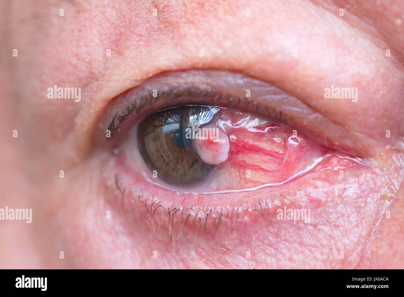 Close up dell'occhio congiuntiva carcinoma a cellule squamose Foto Stock