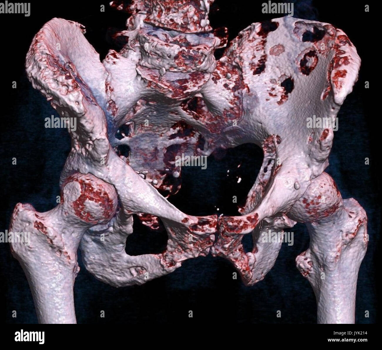 Rendering 3D CT di hip metastasi ossee Foto Stock