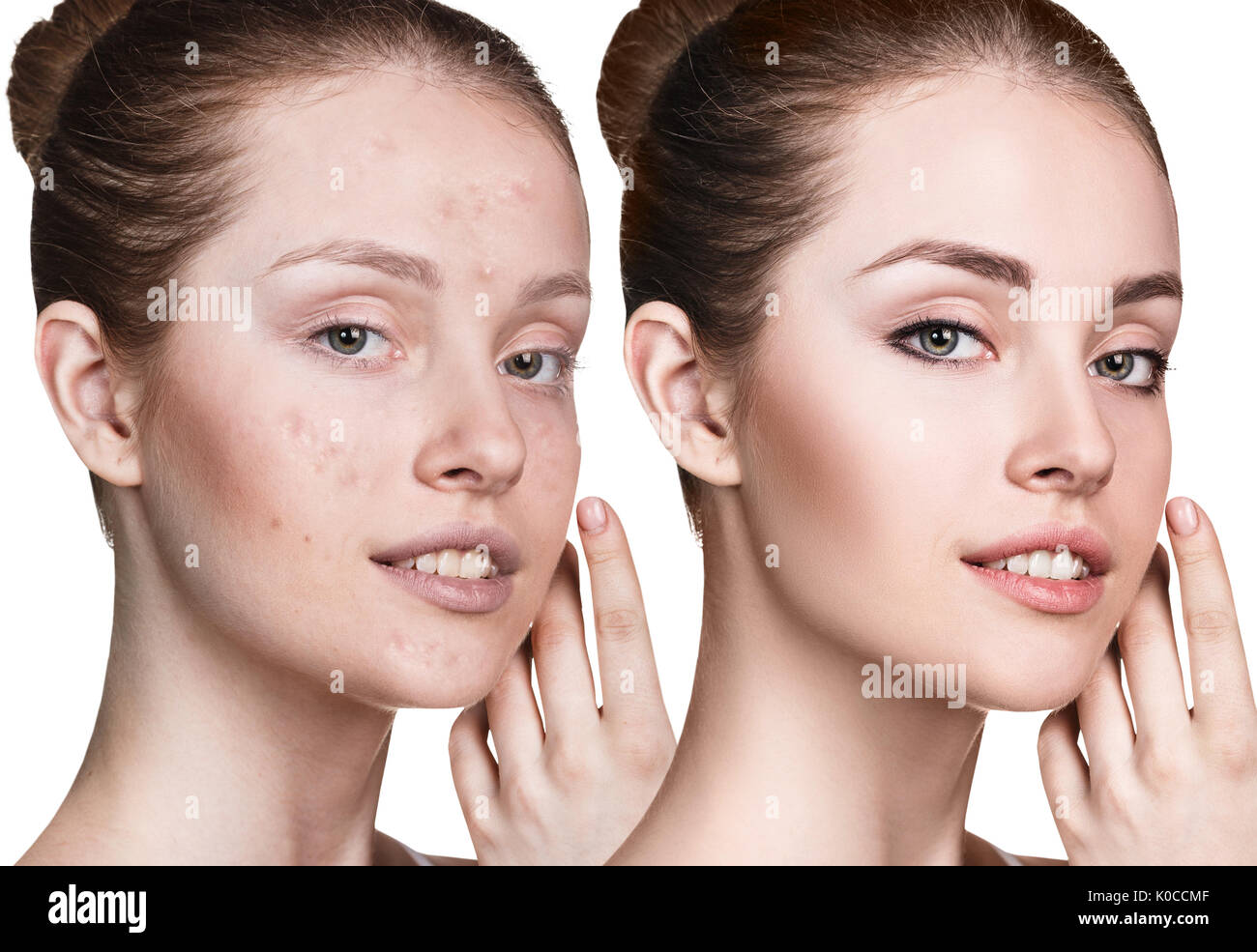 Giovane donna con acne prima e dopo il trattamento Foto Stock