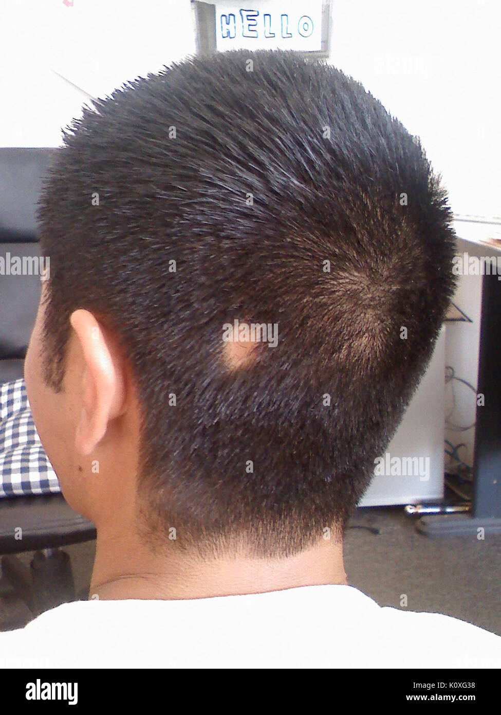 Alopecia areata bald spot Foto Stock