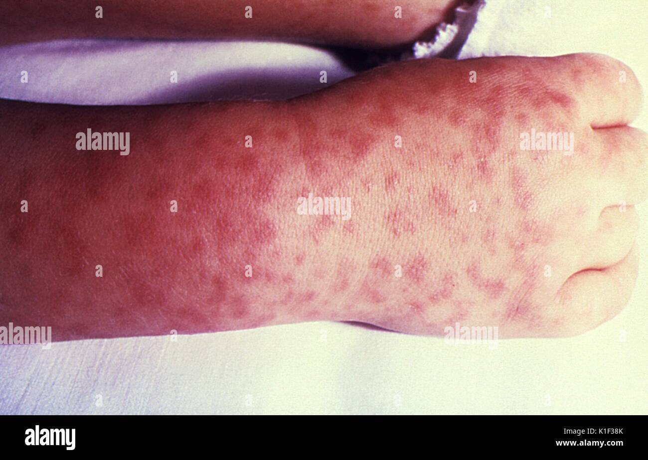 Sul diritto del bambino di mano e polso visualizzando la caratteristica spotted rash di Rocky Mountain spotted fever. Rocky Mountain spotted fever è la più grave e più frequentemente riportati rickettsial malattia negli Stati Uniti. La malattia è causata da Rickettsia rickettsii, una specie di batteri che si diffonde in esseri umani da ixodid (hard) ticks. Immagine cortesia CDC. 1990. Foto Stock